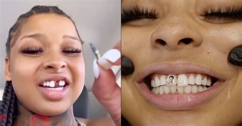 chrisean rock missing teeth|Chrisean Rock Finally Visits Dentist To Fix Her Missing Tooth!